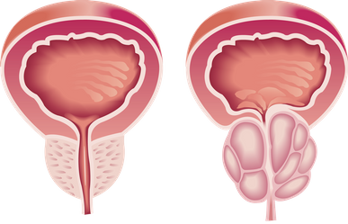 Prostata